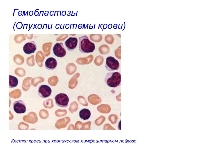 Гемобластозы (Опухоли системы крови) Клетки крови при хроническом лимфоцитарном лейкозе