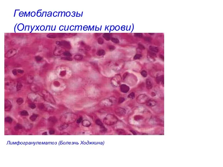 Гемобластозы (Опухоли системы крови) Лимфогранулематоз (Болезнь Ходжкина)