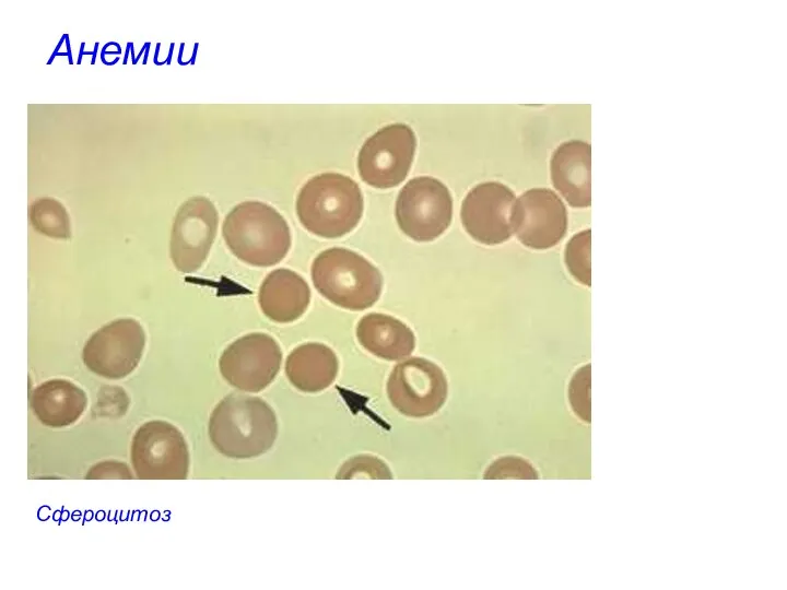 Анемии Сфероцитоз
