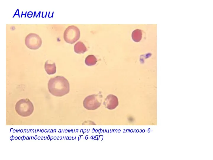 Анемии Гемолитическая анемия при дефиците глюкозо-6-фосфатдегидрогэназы (Г-6-ФДГ)