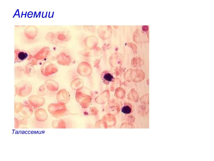 Анемии Талассемия