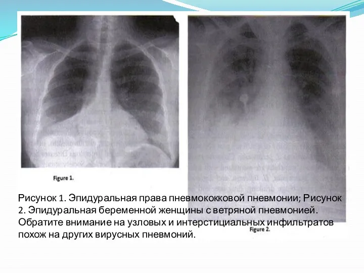 Рисунок 1. Эпидуральная права пневмококковой пневмонии; Рисунок 2. Эпидуральная беременной