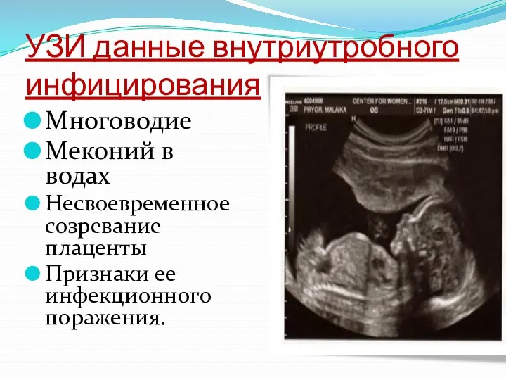 УЗИ данные внутриутробного инфицирования Многоводие Меконий в водах Несвоевременное созревание плаценты Признаки ее инфекционного поражения.