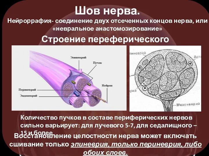 Шов нерва. Нейроррафия- соединение двух отсеченных концов нерва, или «невральное