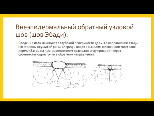 Внеэпидермальный обратный узловой шов (шов Эбади). Введение иглы начинают с