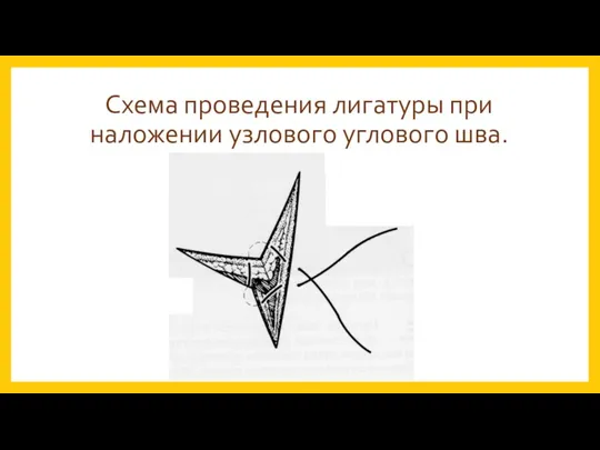 Схема проведения лигатуры при наложении узлового углового шва.