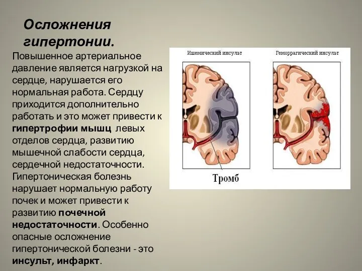 Осложнения гипертонии. Повышенное артериальное давление является нагрузкой на сердце, нарушается