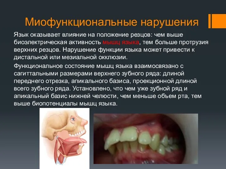 Миофункциональные нарушения Язык оказывает влияние на положение резцов: чем выше