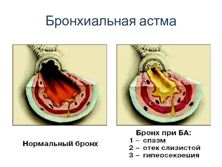 Бронхиальная астма