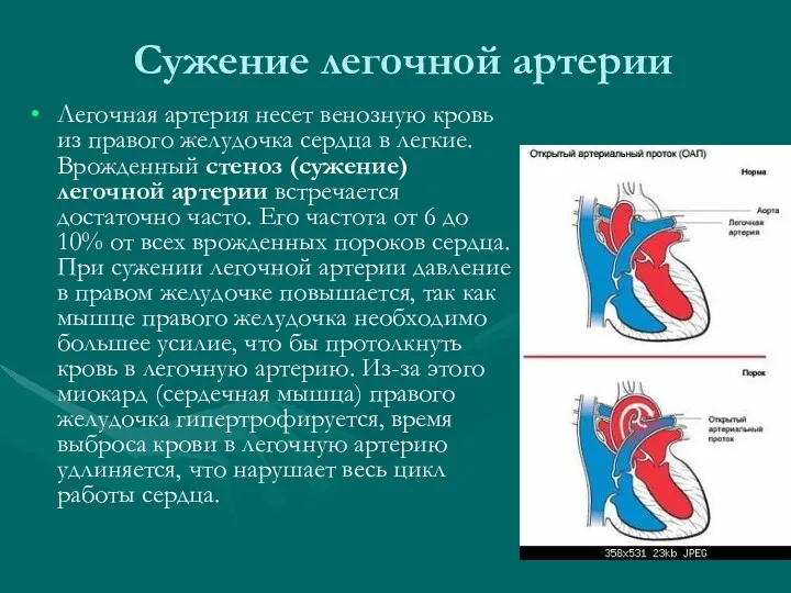 Сужение легочной артерии Легочная артерия несет венозную кровь из правого