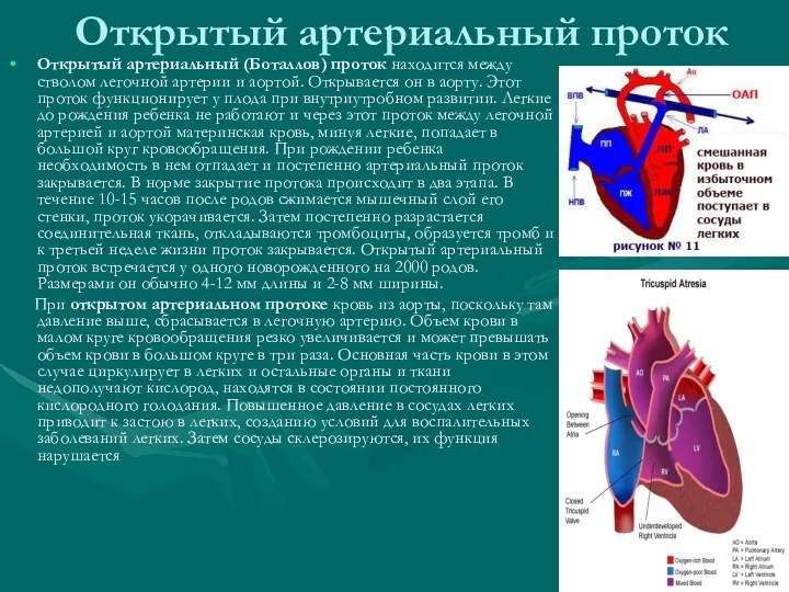Открытый артериальный проток Открытый артериальный (Боталлов) проток находится между стволом