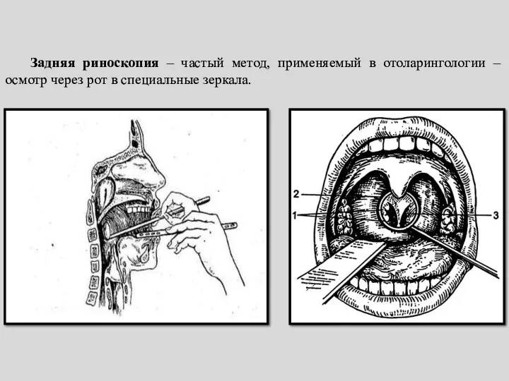 Задняя риноскопия – частый метод, применяемый в отоларингологии – осмотр через рот в специальные зеркала.