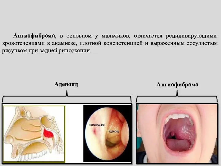 Аденоид Ангиофиброма Ангиофиброма, в основном у мальчиков, отличается рецидивирующими кровотечениями
