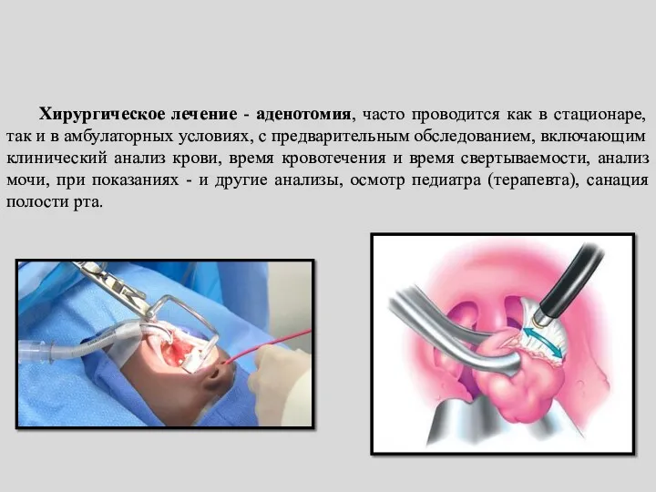 Хирургическое лечение - аденотомия, часто проводится как в стационаре, так