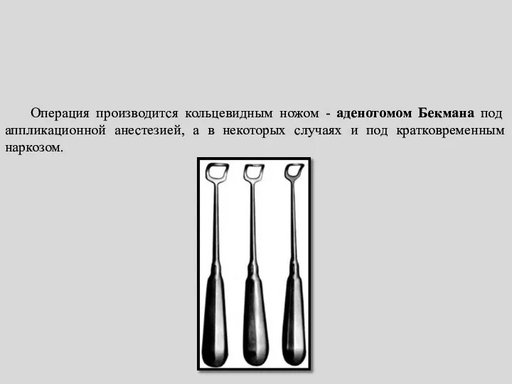 Операция производится кольцевидным ножом - аденотомом Бекмана под аппликационной анестезией,