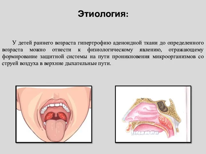 Этиология: У детей раннего возраста гипертрофию аденоидной ткани до определенного