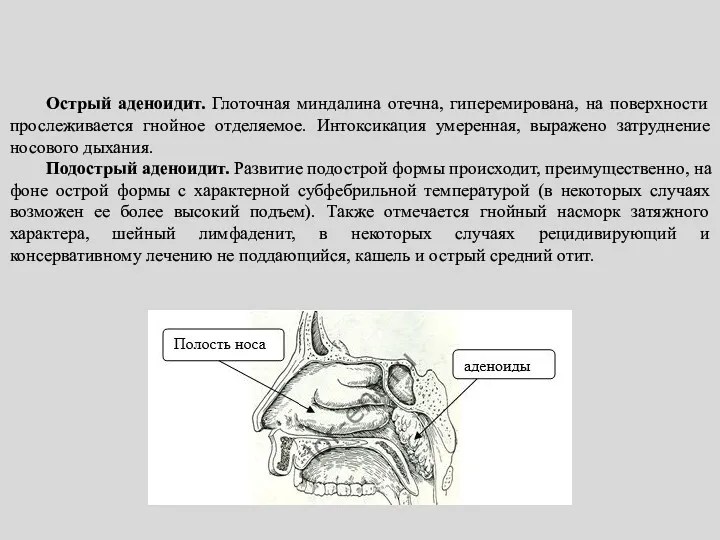 Острый аденоидит. Глоточная миндалина отечна, гиперемирована, на поверхности прослеживается гнойное