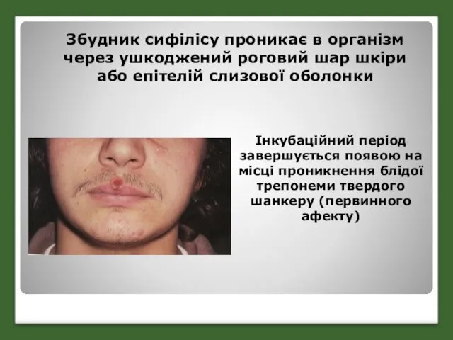 Збудник сифілісу проникає в організм через ушкоджений роговий шар шкіри