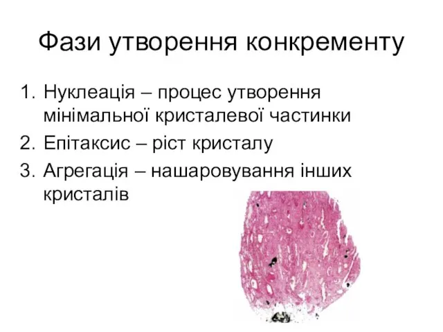 Фази утворення конкременту Нуклеація – процес утворення мінімальної кристалевої частинки