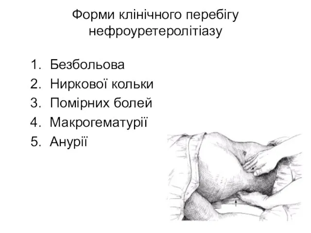 Форми клінічного перебігу нефроуретеролітіазу 1. Безбольова 2. Ниркової кольки 3. Помірних болей 4. Макрогематурії 5. Анурії