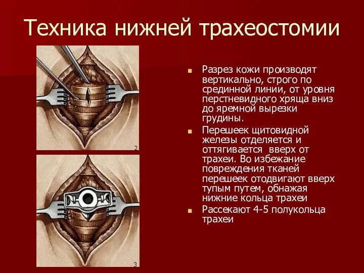 Техника нижней трахеостомии Разрез кожи производят вертикально, строго по срединной