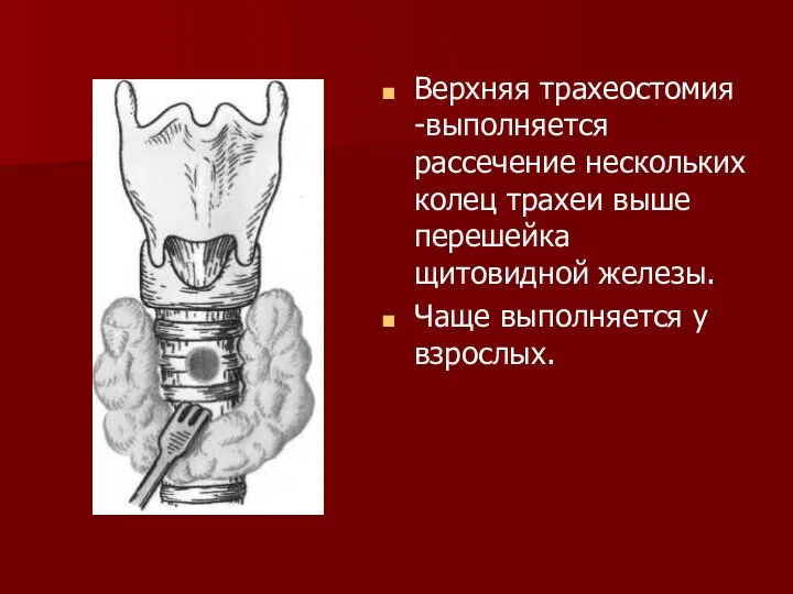 Верхняя трахеостомия -выполняется рассечение нескольких колец трахеи выше перешейка щитовидной железы. Чаще выполняется у взрослых.