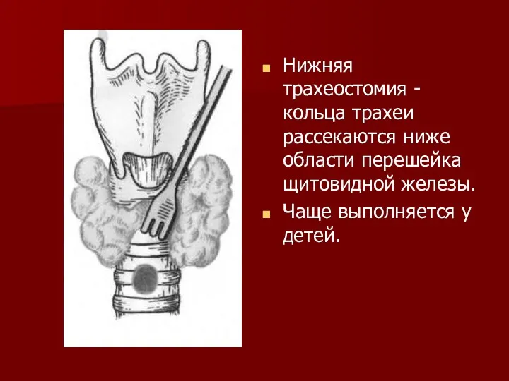 Нижняя трахеостомия -кольца трахеи рассекаются ниже области перешейка щитовидной железы. Чаще выполняется у детей.