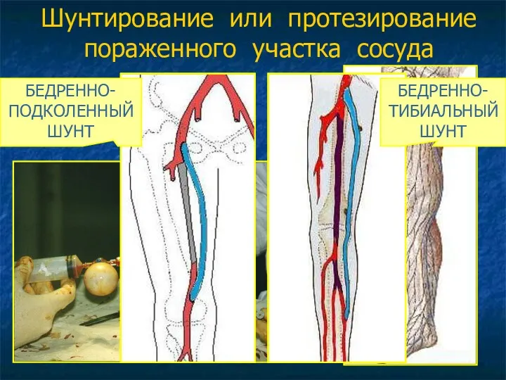 Шунтирование или протезирование пораженного участка сосуда АУТОВЕНОЗНОЕ ШУНТИРОВАНИЕ БЕДРЕННО-ПОДКОЛЕННЫЙ ШУНТ БЕДРЕННО-ТИБИАЛЬНЫЙ ШУНТ