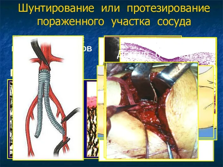 Шунтирование или протезирование пораженного участка сосуда СИНТЕТИЧЕСКИЕ ПРОТЕЗЫ СОСУДОВ ТКАНЫЕ ПЛЕТЕНЫЕ ВЯЗАНЫЕ ПТФЭ Доступ по Робу