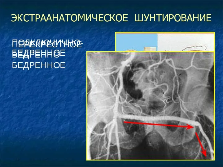 ЭКСТРААНАТОМИЧЕСКОЕ ШУНТИРОВАНИЕ ПОДКЛЮЧИЧНО-БЕДРЕННОЕ ПЕРЕКРЕСТНОЕ БЕДРЕННО-БЕДРЕННОЕ