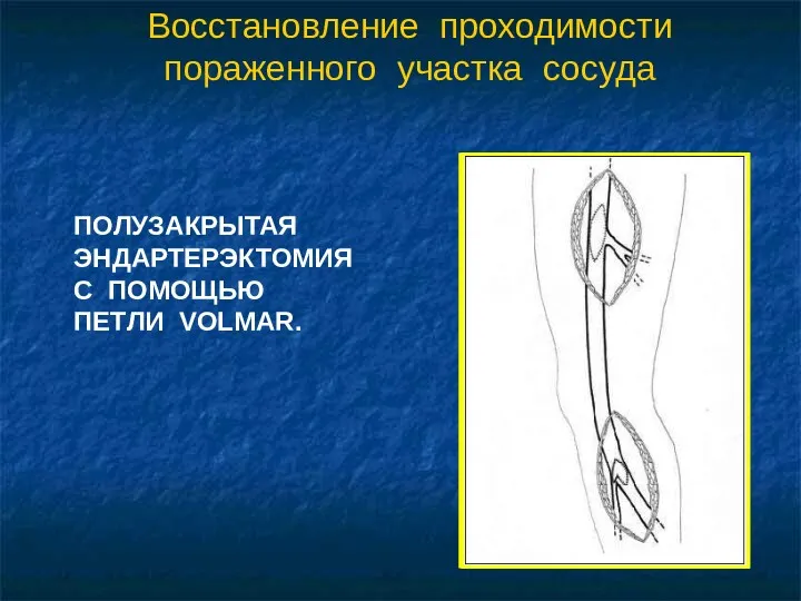 Восстановление проходимости пораженного участка сосуда ПОЛУЗАКРЫТАЯ ЭНДАРТЕРЭКТОМИЯ С ПОМОЩЬЮ ПЕТЛИ VOLMAR.