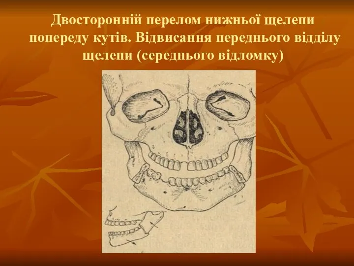 Двосторонній перелом нижньої щелепи попереду кутів. Відвисання переднього відділу щелепи (середнього відломку)