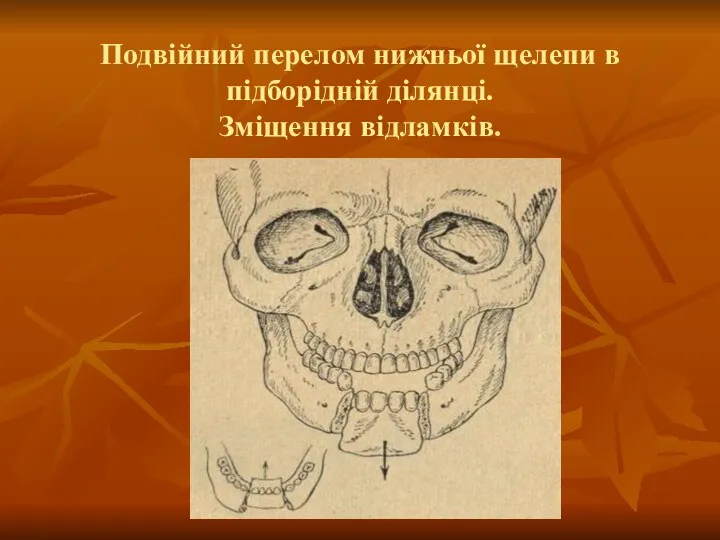 Подвійний перелом нижньої щелепи в підборідній ділянці. Зміщення відламків.