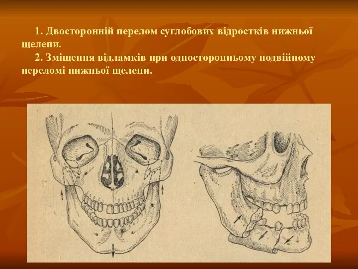 1. Двосторонній перелом суглобових відростків нижньої щелепи. 2. Зміщення відламків при односторонньому подвійному переломі нижньої щелепи.