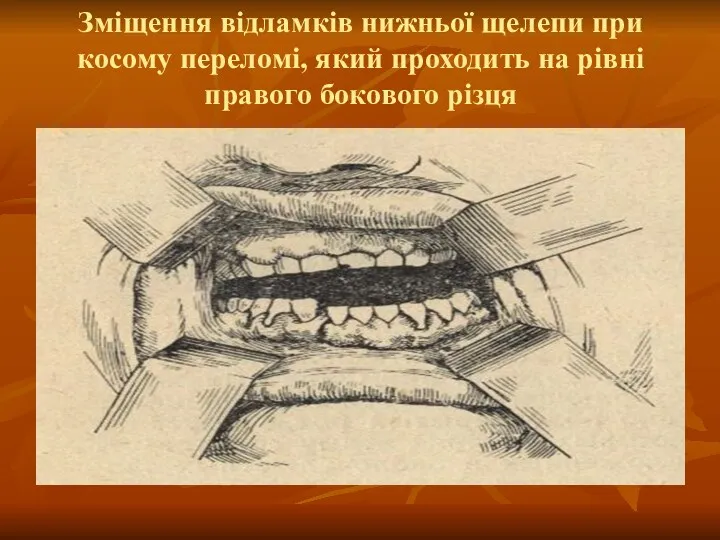 Зміщення відламків нижньої щелепи при косому переломі, який проходить на рівні правого бокового різця