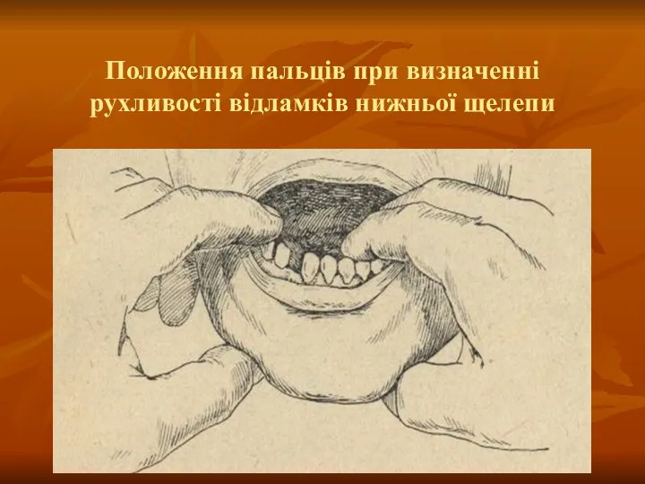 Положення пальців при визначенні рухливості відламків нижньої щелепи