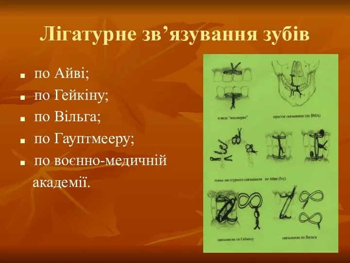 Лігатурне зв’язування зубів по Айві; по Гейкіну; по Вільга; по Гауптмееру; по воєнно-медичній академії.