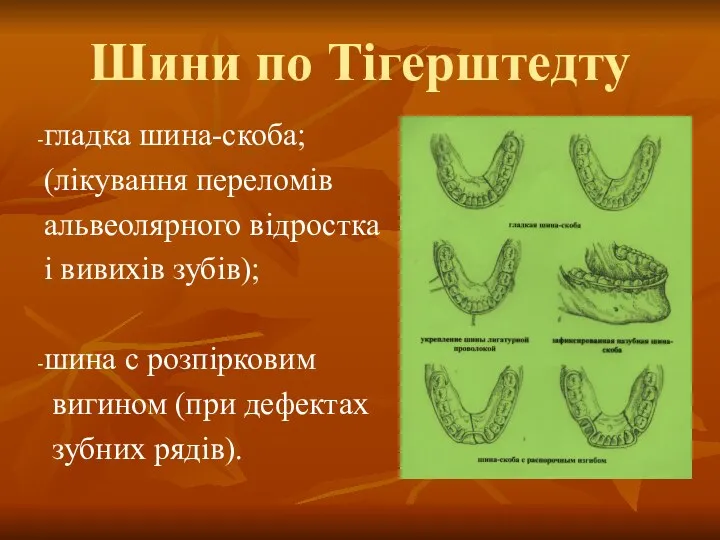 Шини по Тігерштедту гладка шина-скоба; (лікування переломів альвеолярного відростка і