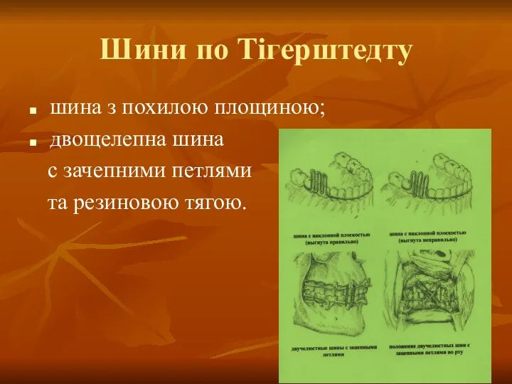 Шини по Тігерштедту шина з похилою площиною; двощелепна шина с зачепними петлями та резиновою тягою.