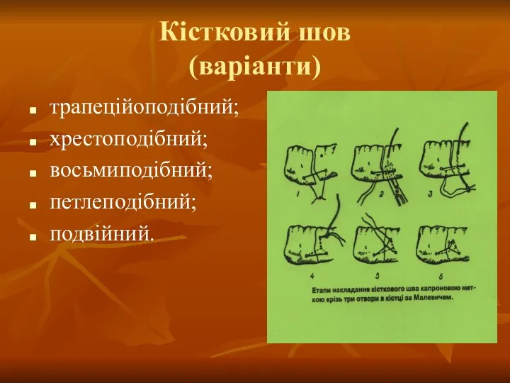 Кістковий шов (варіанти) трапеційоподібний; хрестоподібний; восьмиподібний; петлеподібний; подвійний.