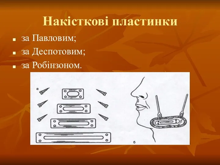 Накісткові пластинки за Павловим; за Деспотовим; за Робінзоном.