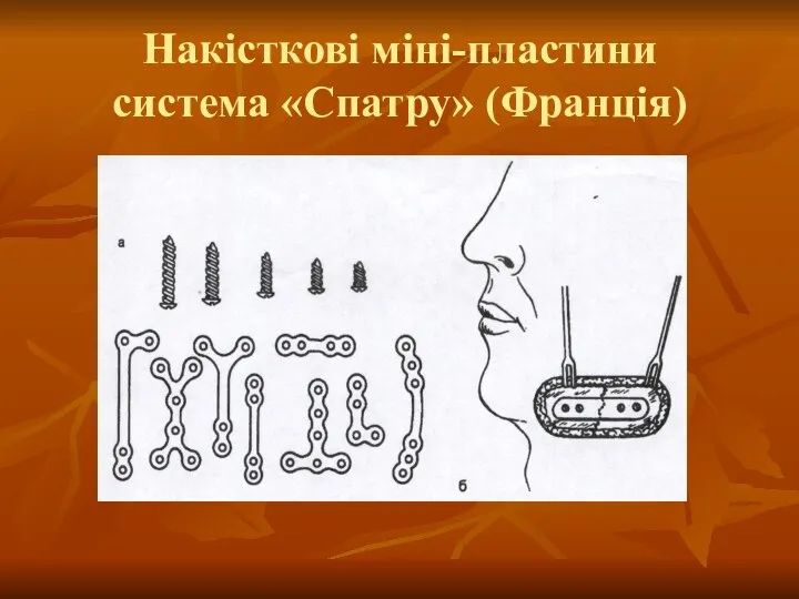 Накісткові міні-пластини система «Спатру» (Франція)