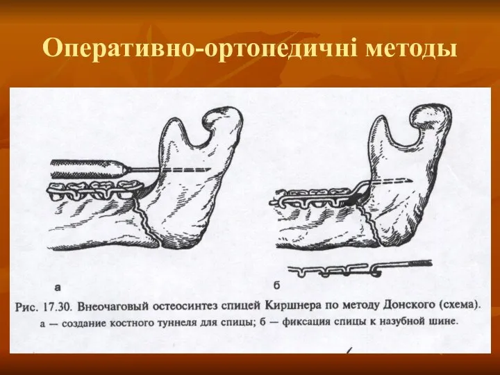 Оперативно-ортопедичні методы