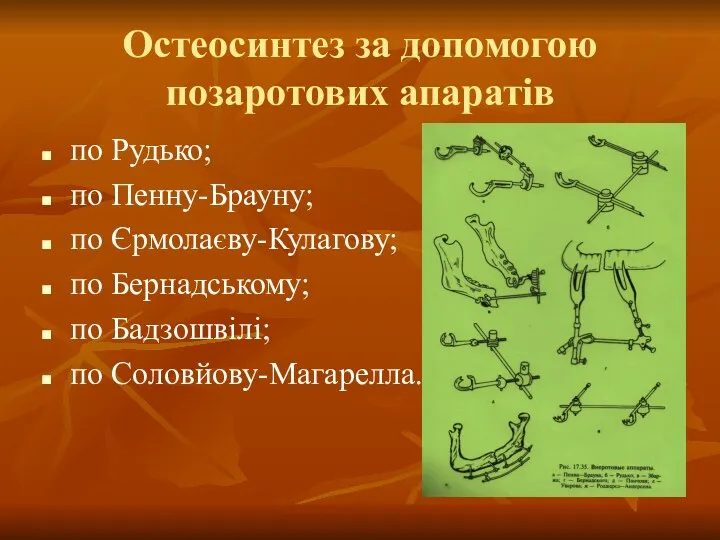 Остеосинтез за допомогою позаротових апаратів по Рудько; по Пенну-Брауну; по