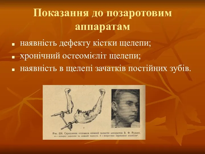 Показання до позаротовим аппаратам наявність дефекту кістки щелепи; хронічний остеомієліт