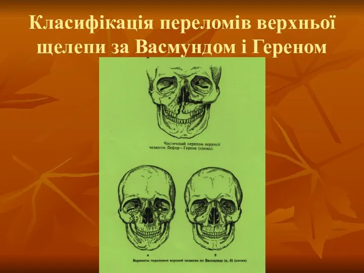 Класифікація переломів верхньої щелепи за Васмундом і Гереном