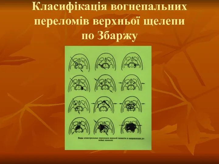 Класифікація вогнепальних переломів верхньої щелепи по Збаржу