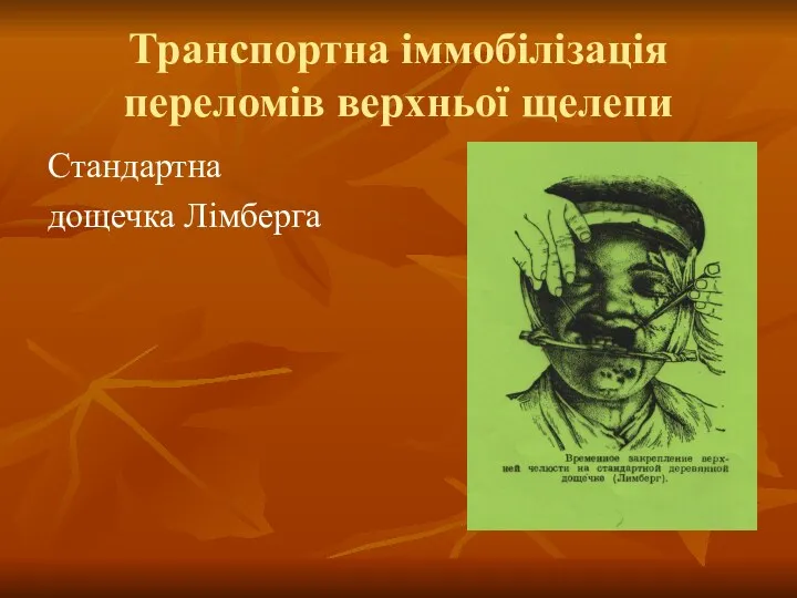 Транспортна іммобілізація переломів верхньої щелепи Стандартна дощечка Лімберга