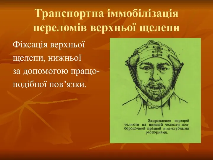 Транспортна іммобілізація переломів верхньої щелепи Фіксація верхньої щелепи, нижньої за допомогою пращо- подібної пов’язки.