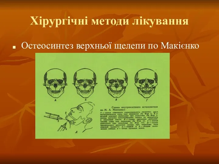 Хірургічні методи лікування Остеосинтез верхньої щелепи по Макієнко